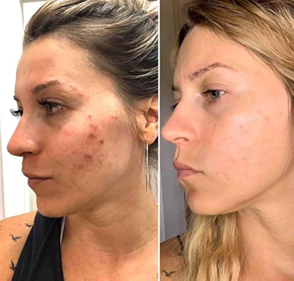 CLEANSER acné (limpiador LumiSpa- piel con acné)